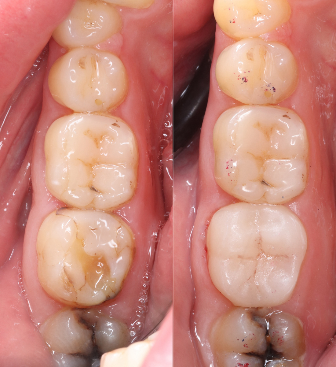 Onlay before and after at St James Dental Surgery