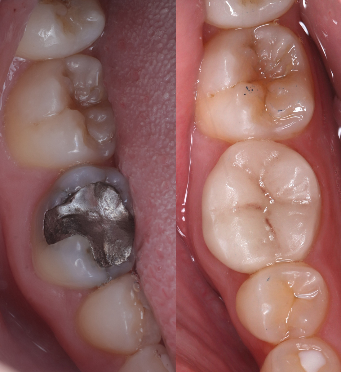 Crowns before and after
