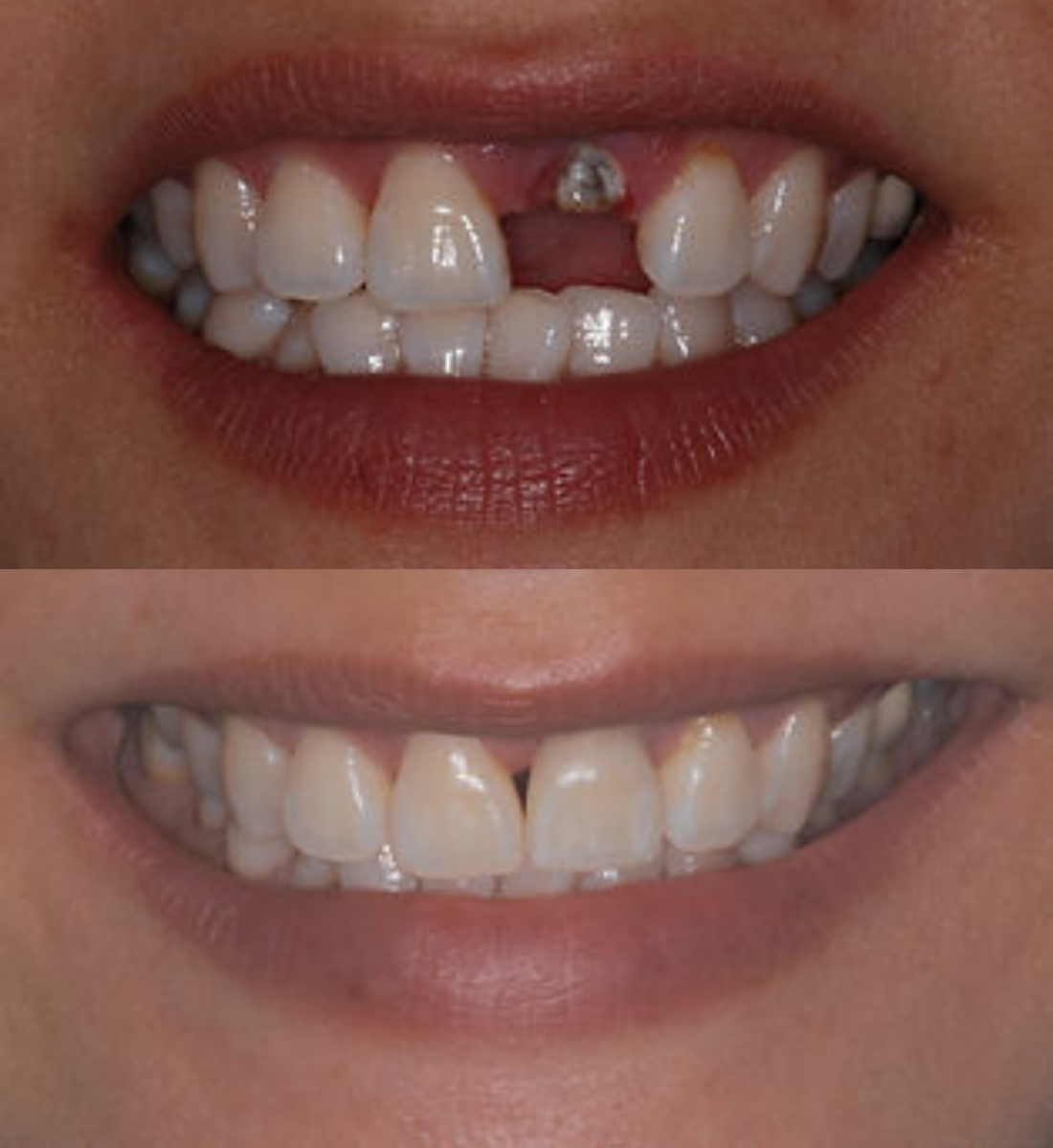 Single tooth dental implant before and after