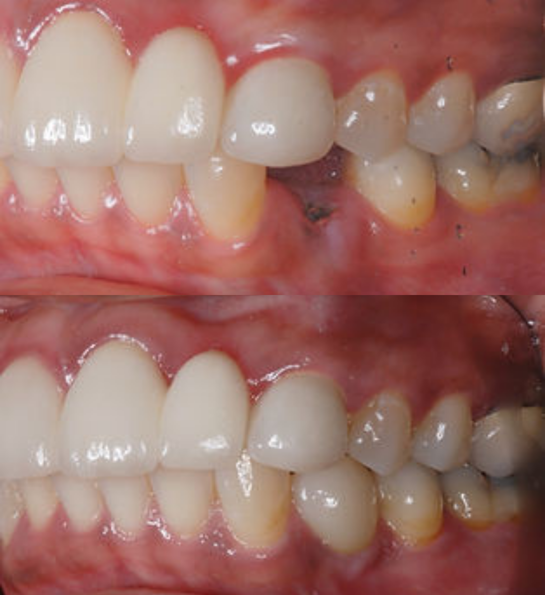 Single tooth dental implant before and after