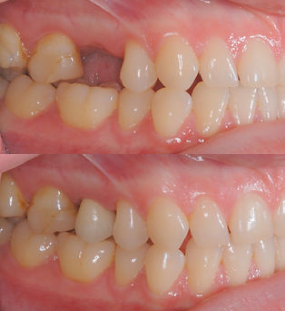 Single tooth dental implant before and after