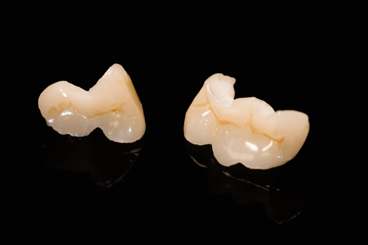 Dental onlay restoration