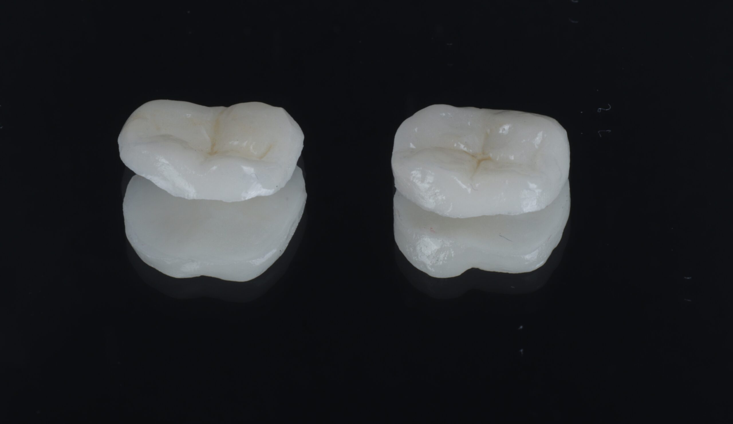 Onlay consultation at St James Dental Surgery in Muswell Hill