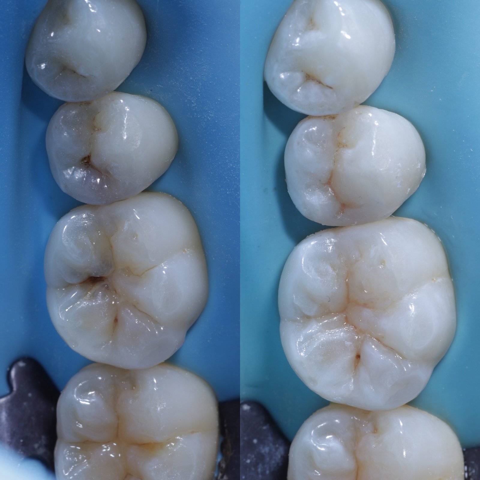 Biomimetic composite fillings before and after
