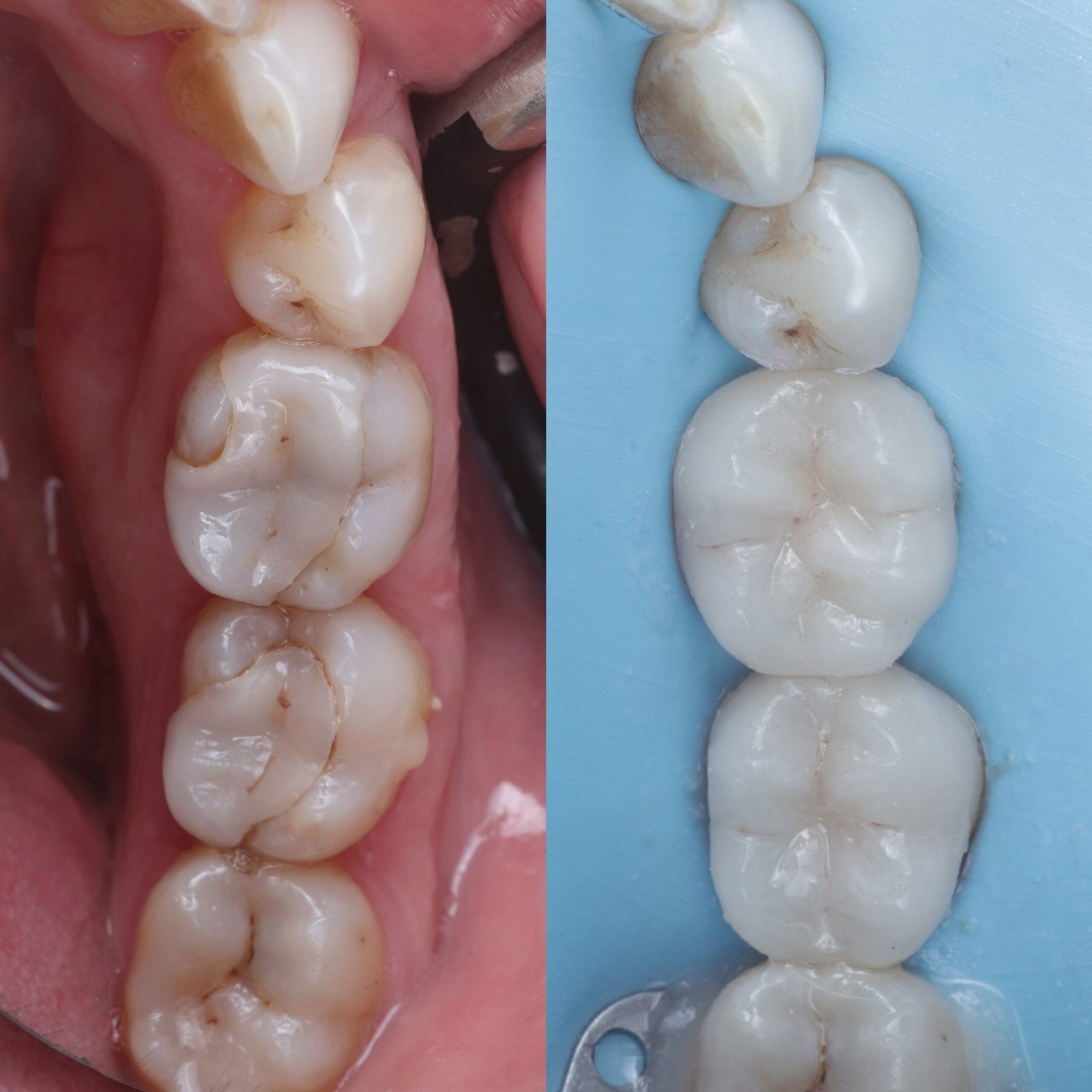 Onlay before and after, case three