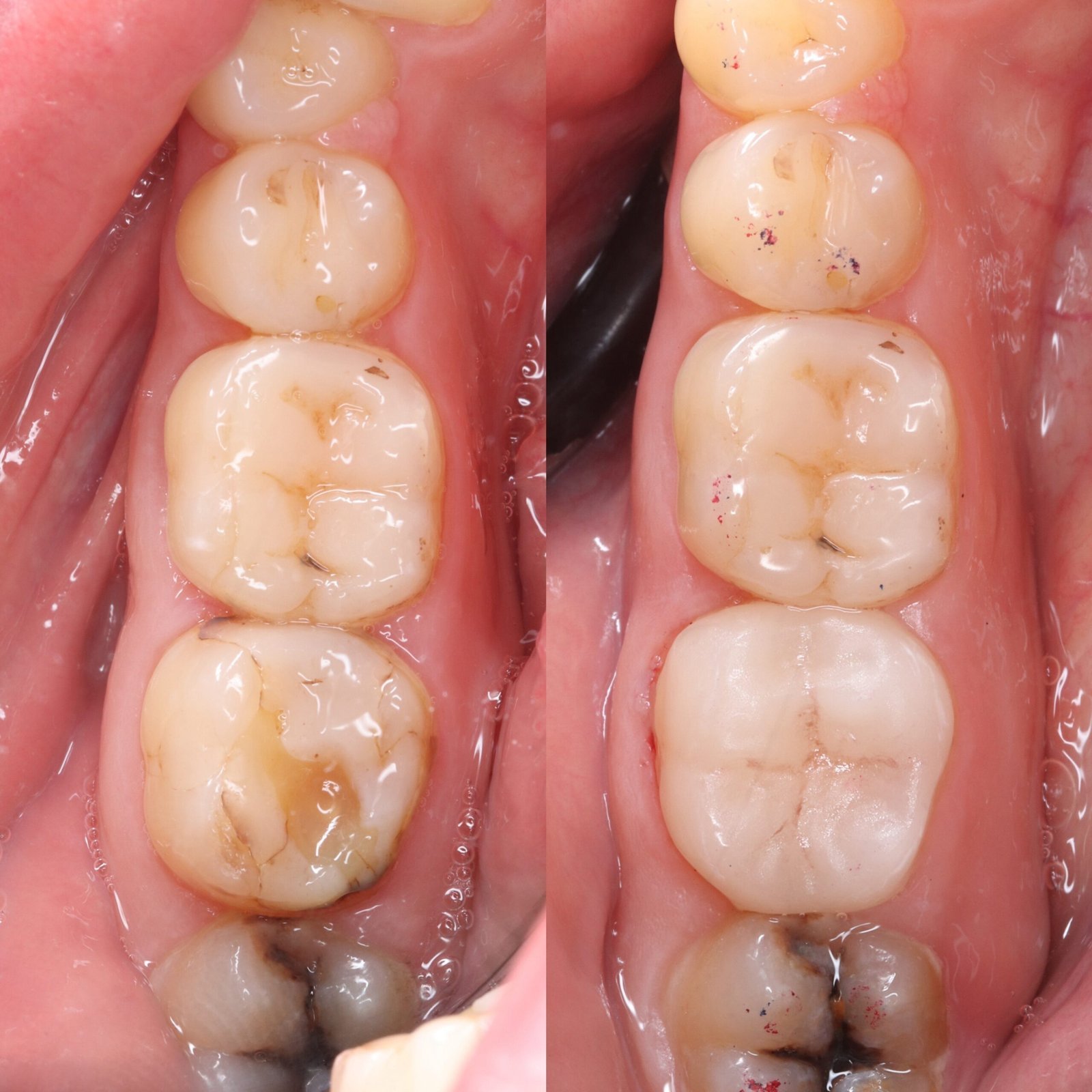 Onlays before and after
