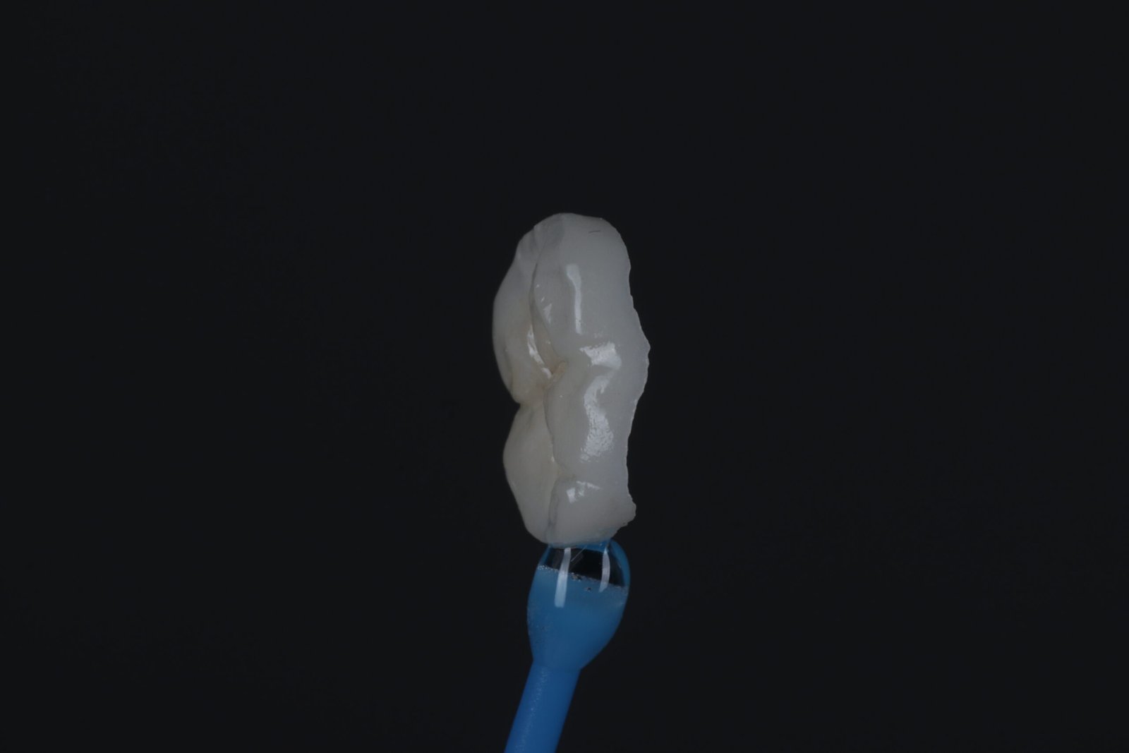 Onlay restoration at St James Dental Surgery in Muswell Hill