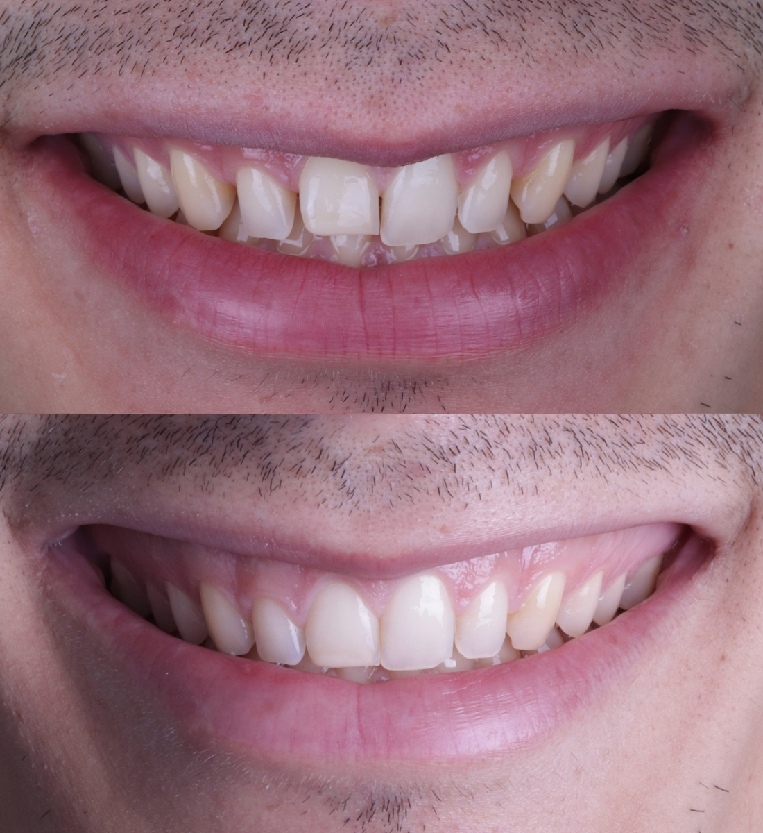 Composite bonding before and after