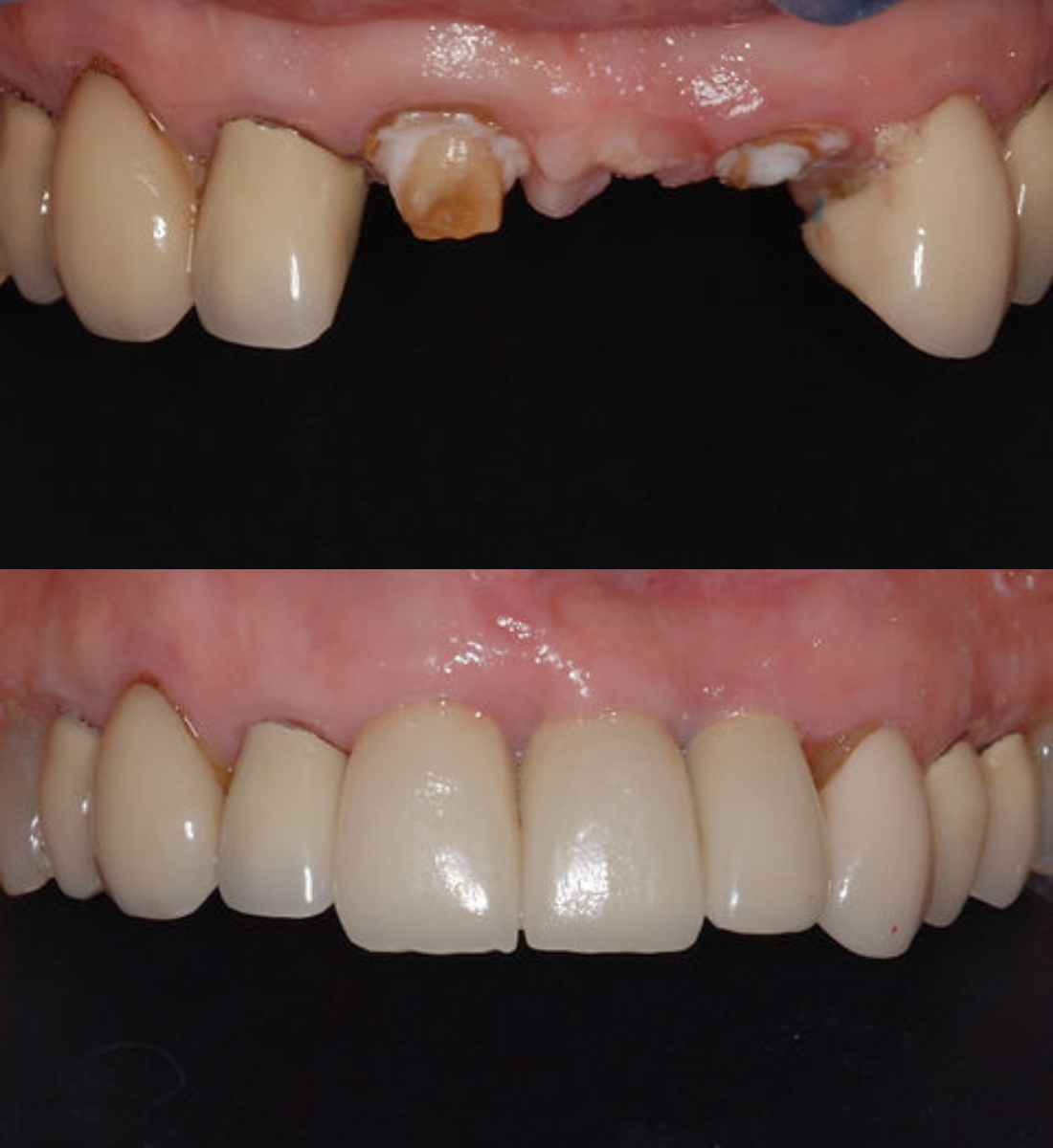 Multiple front teeth implants before and after