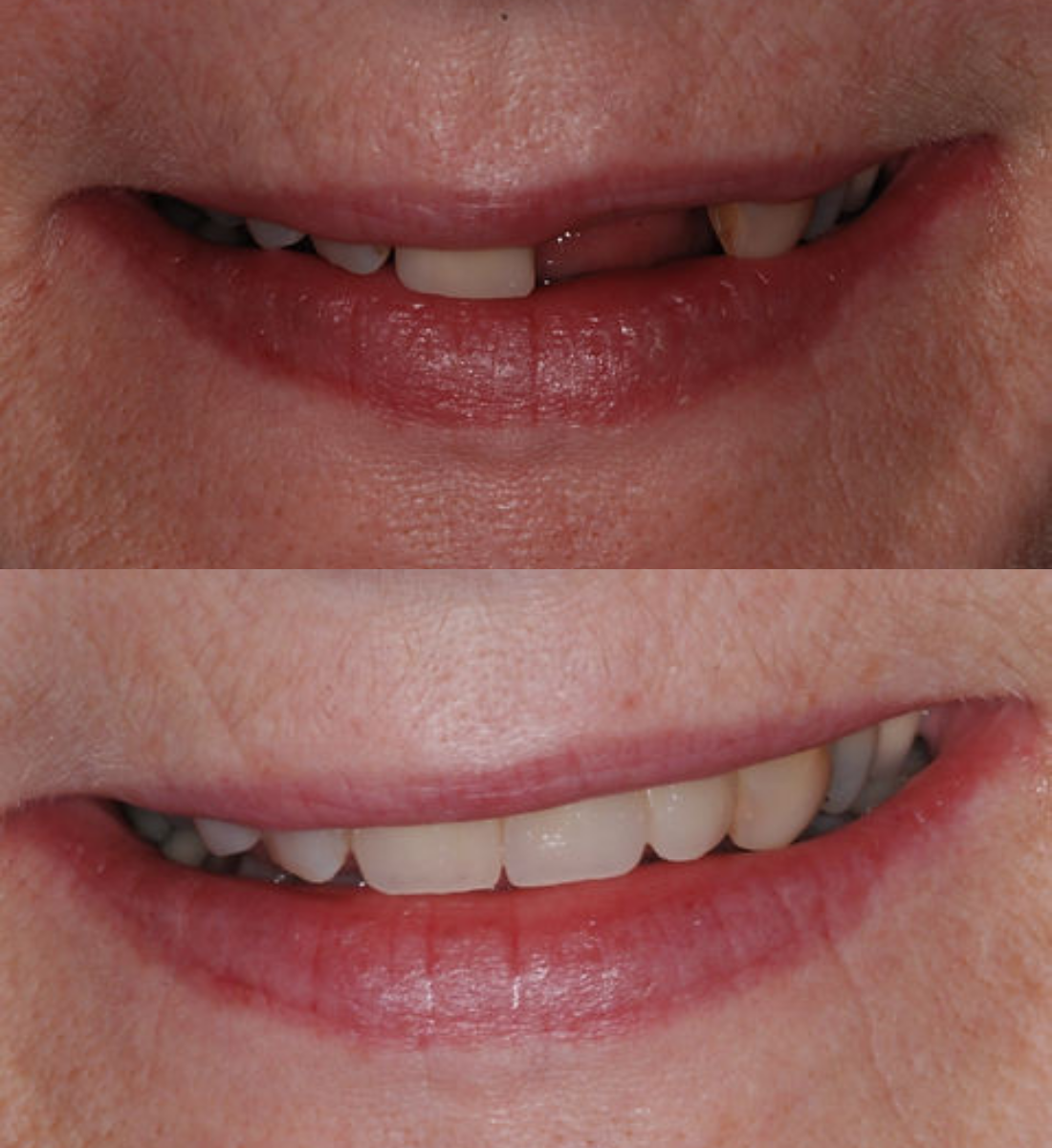 Multiple tooth dental implants before and after