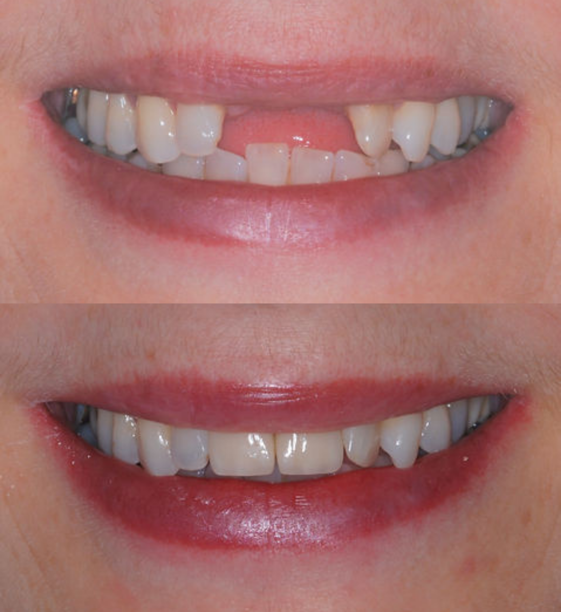 Multiple front teeth implants before and after