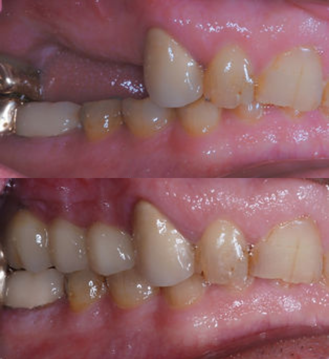 Multiple tooth dental implants before and after
