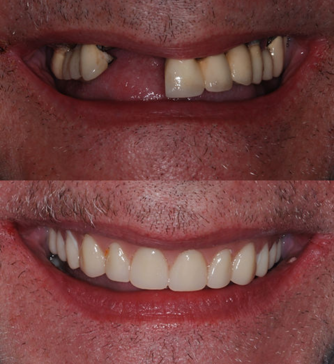 Implant retained dentures before and after