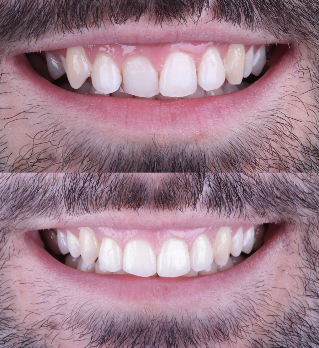 Invisalign straightening before and after