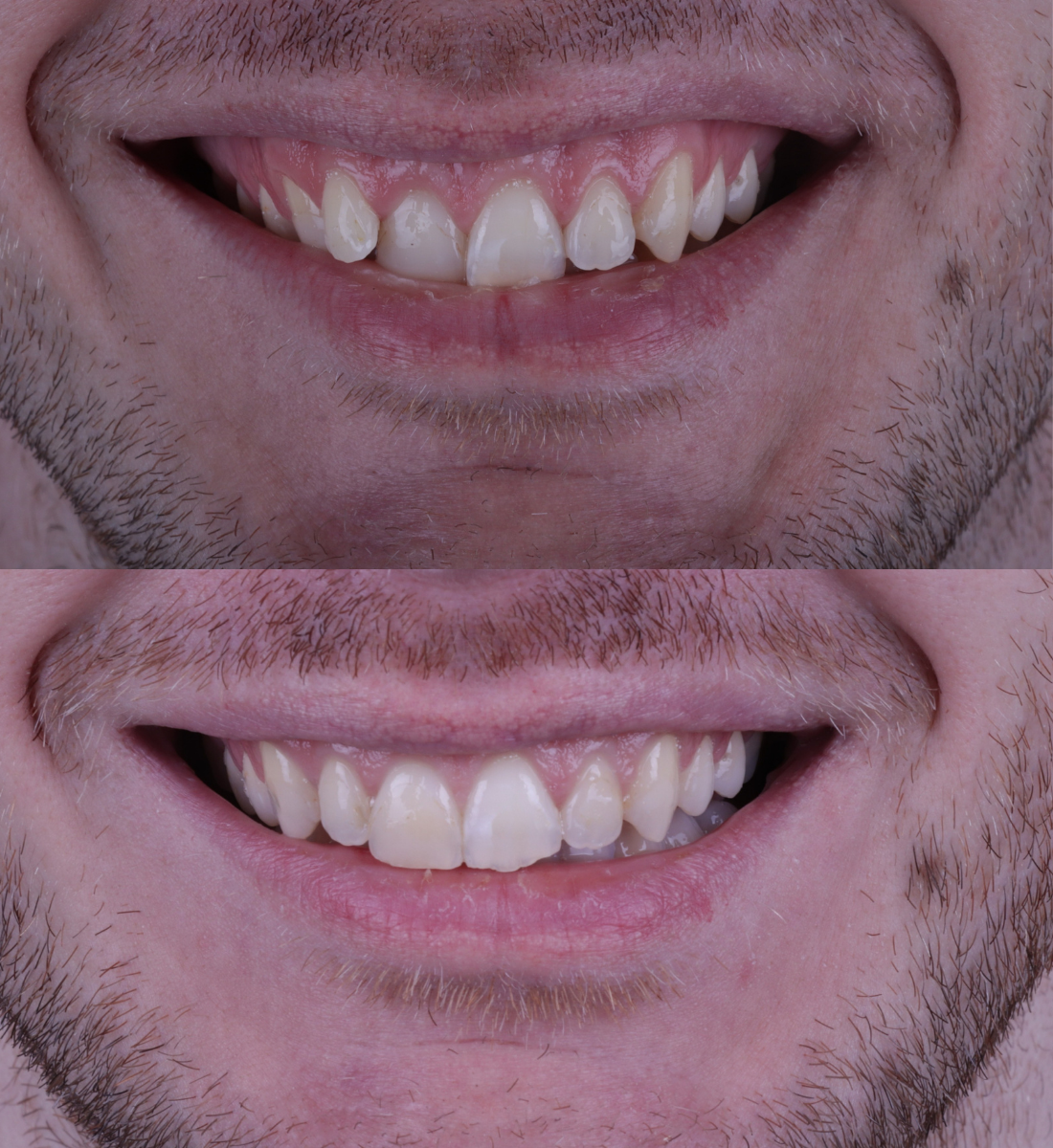 Invisalign straightening before and after