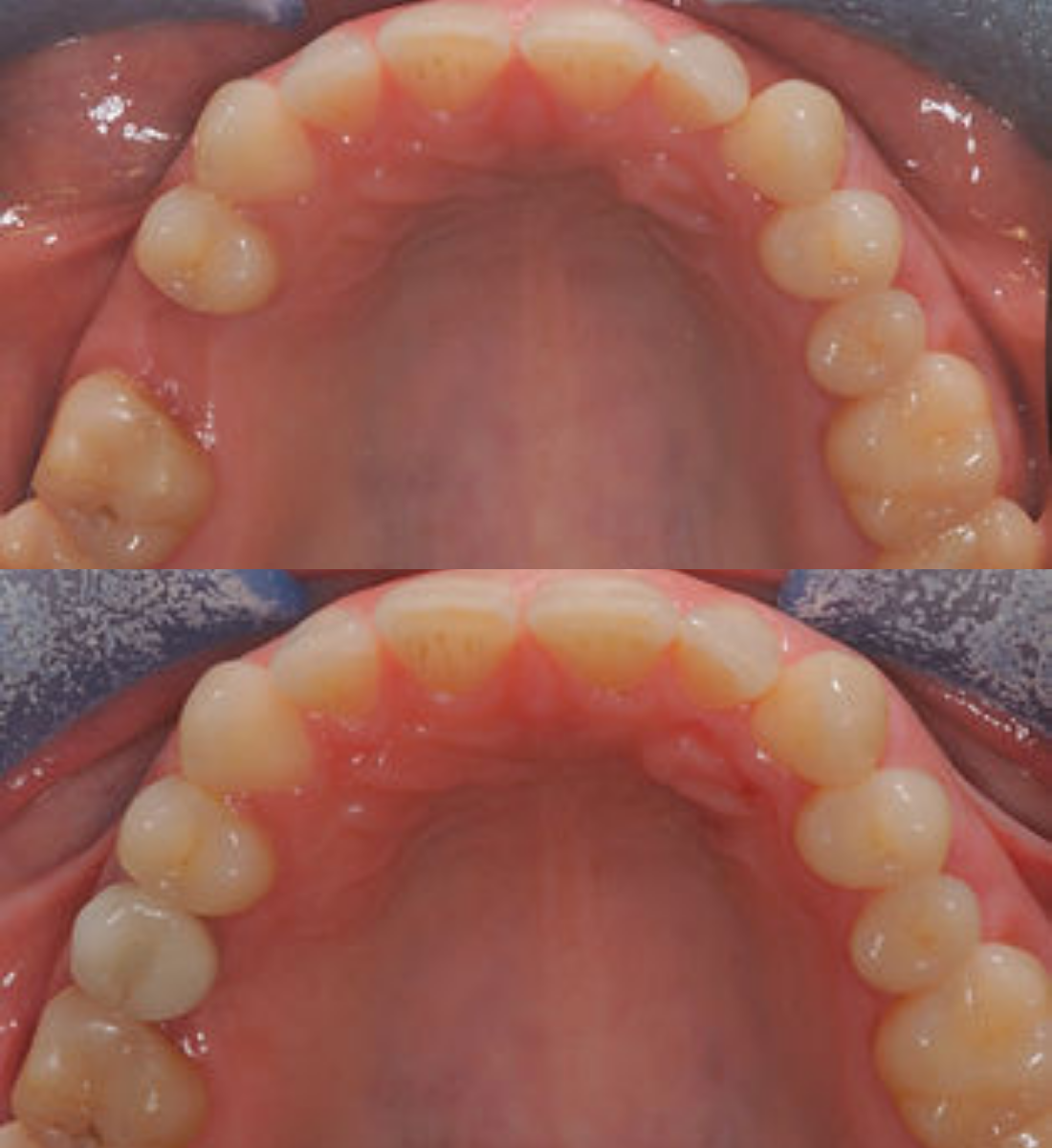 Single tooth dental implant before and after