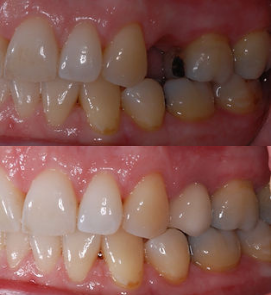 Single tooth dental implant before and after