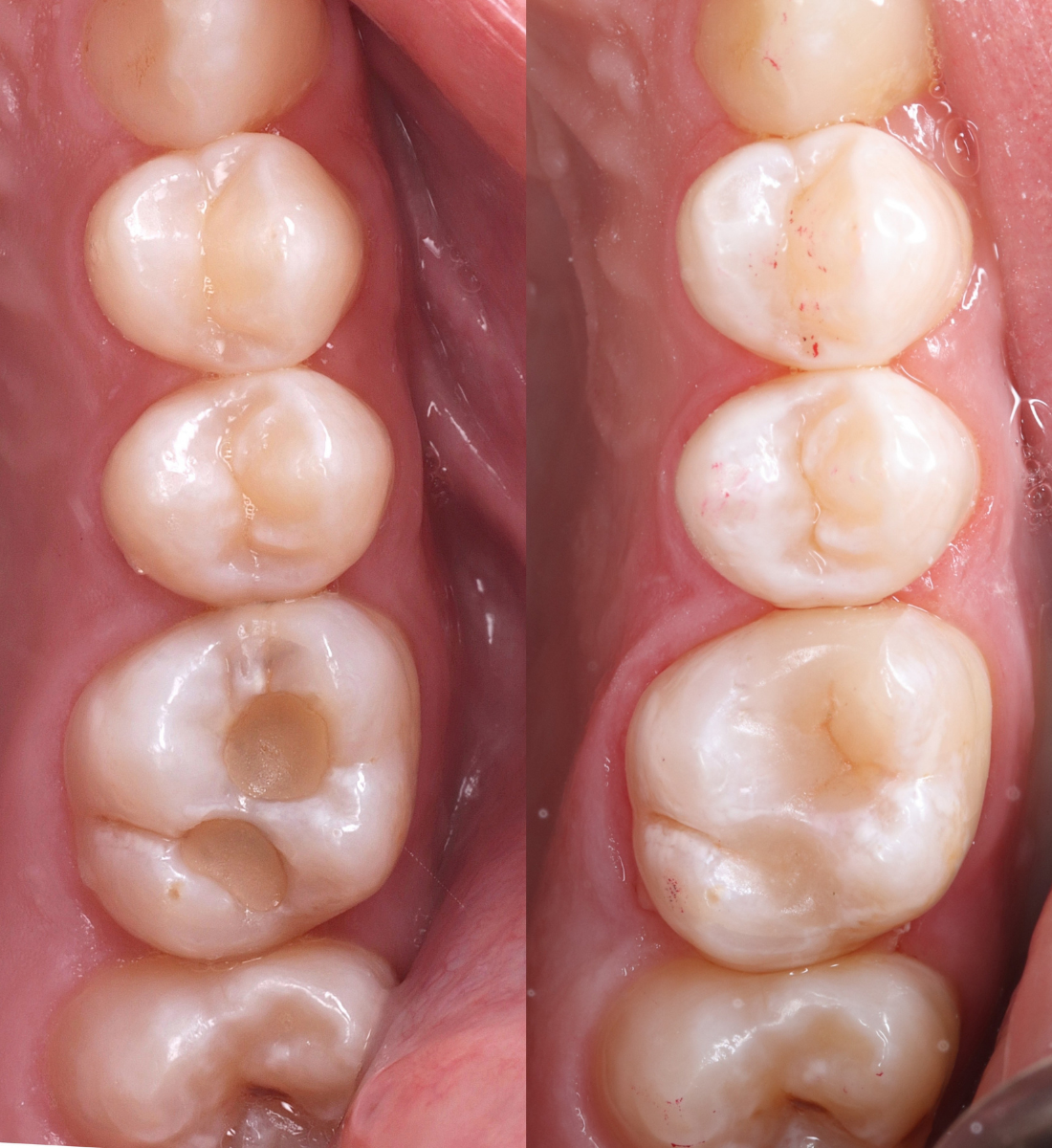 Biomimetic dentistry before and after