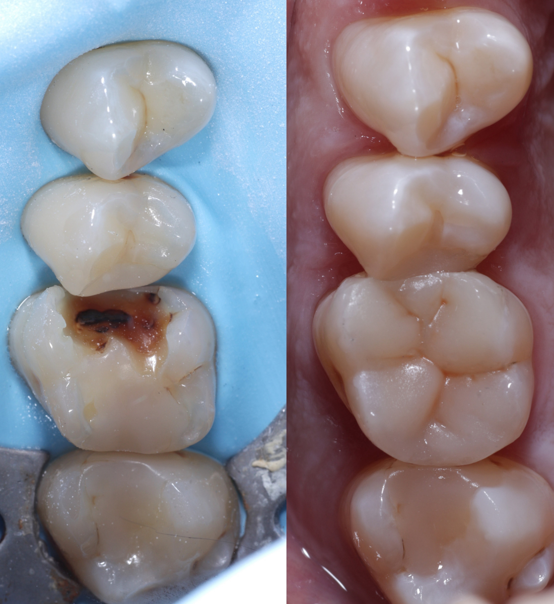 Biomimetic dentistry before and after, case eleven