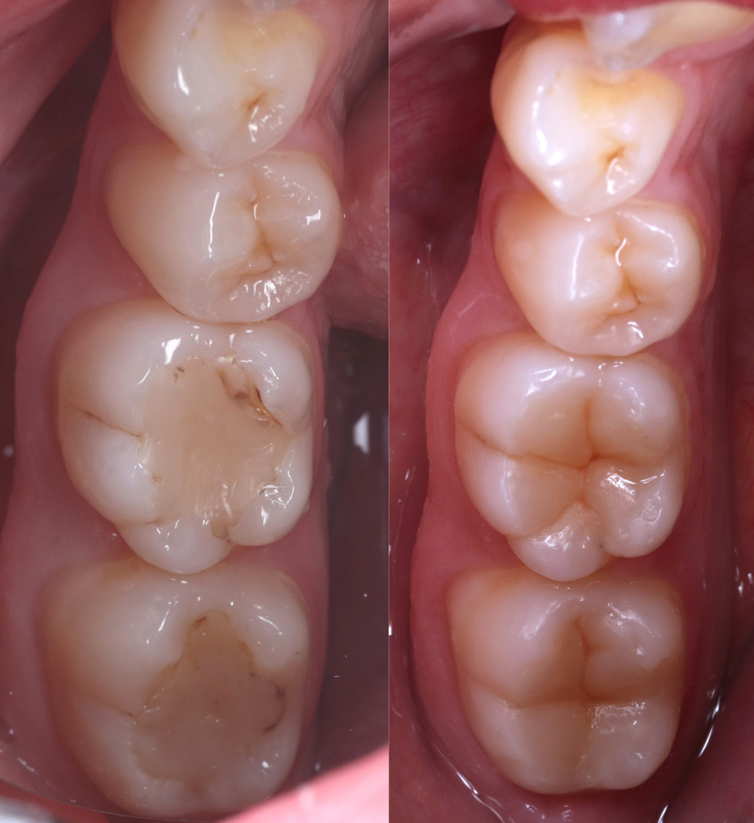 Biomimetic dentistry before and after