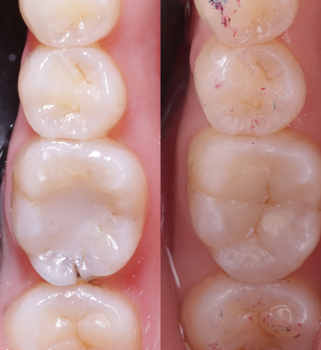 Biomimetic dentistry before and after, case four