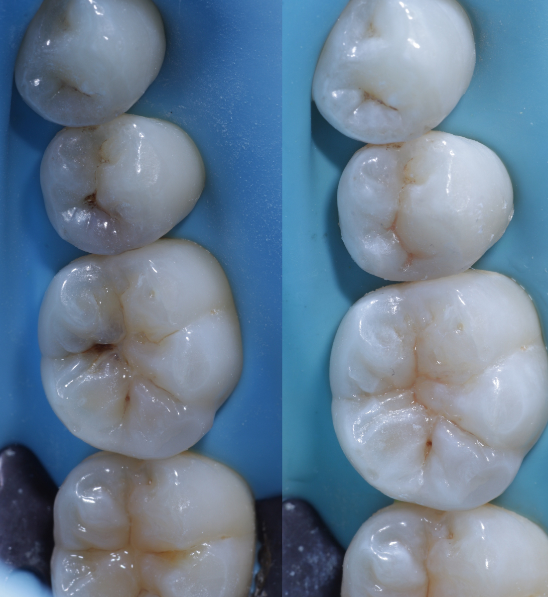 Biomimetic dentistry before and after