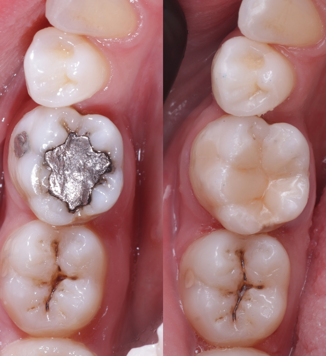 Biomimetic dentistry before and after, case nine