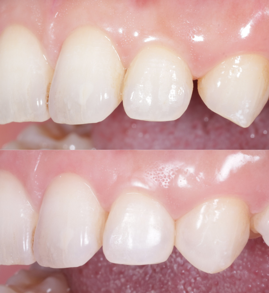 Composite bonding before and after