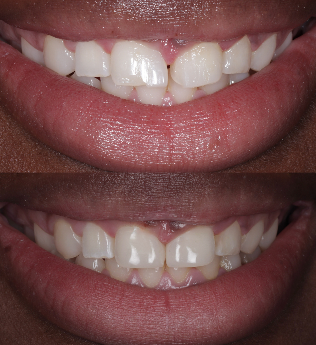 Composite bonding before and after