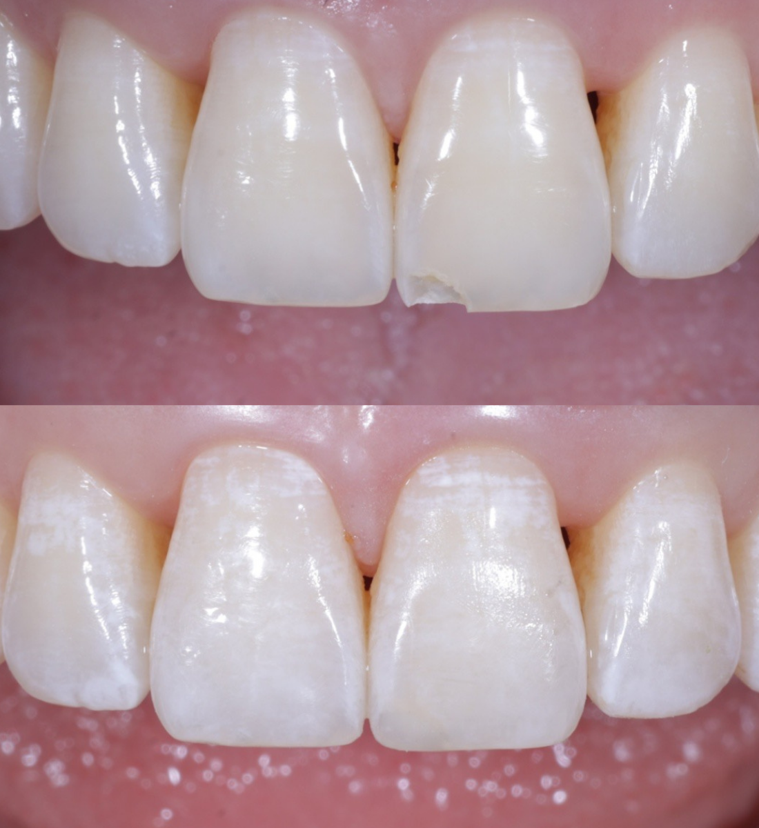 Composite bonding before and after, case four