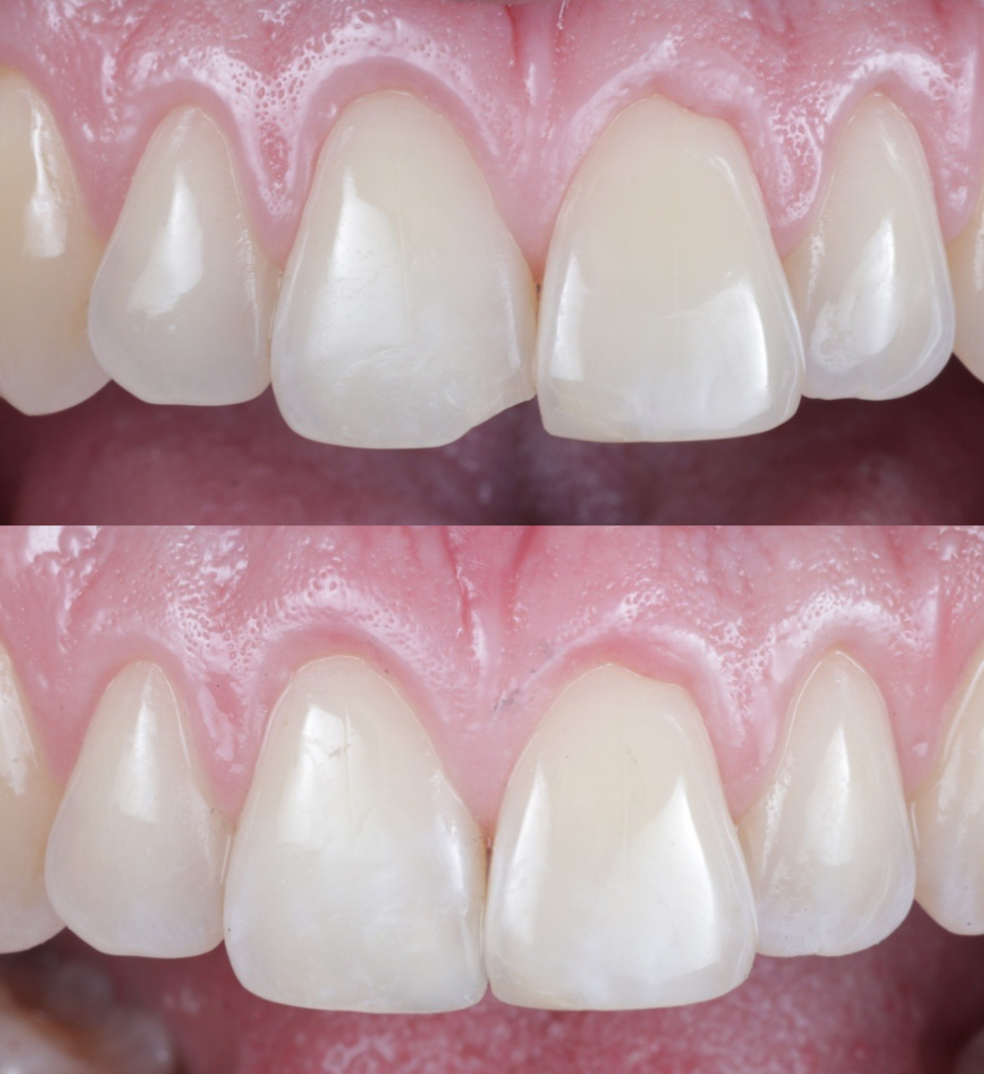 Composite bonding before and after