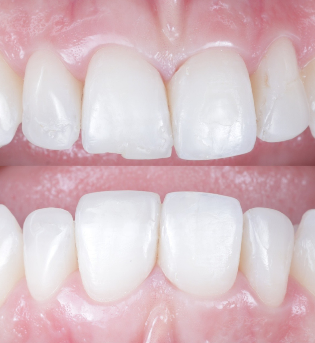 Composite bonding before and after, case six