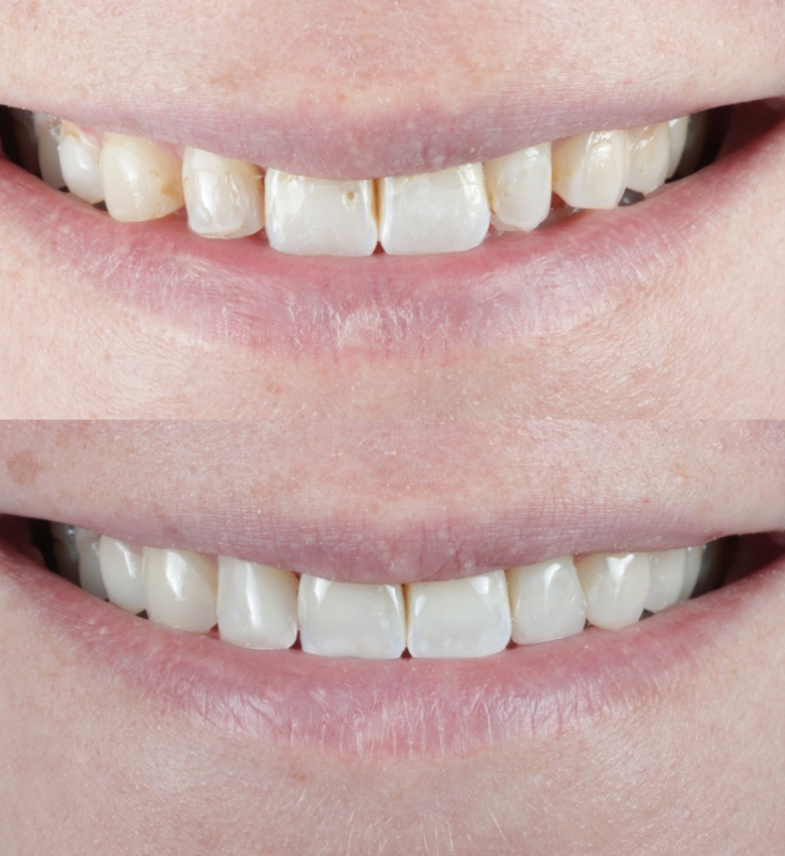 Composite bonding before and after