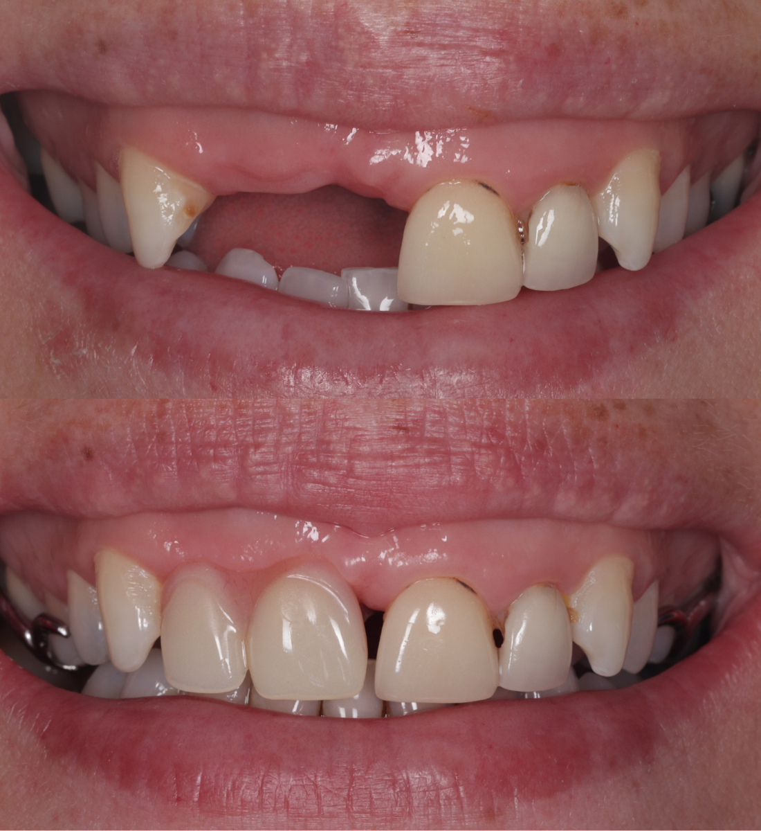 Dentures before and after, case two