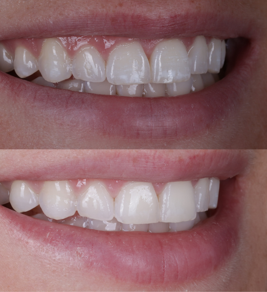 ICON treatment before and after