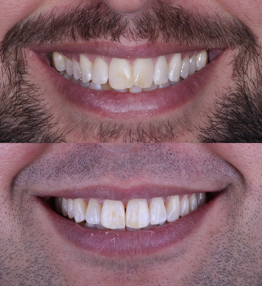 Invisalign before and after