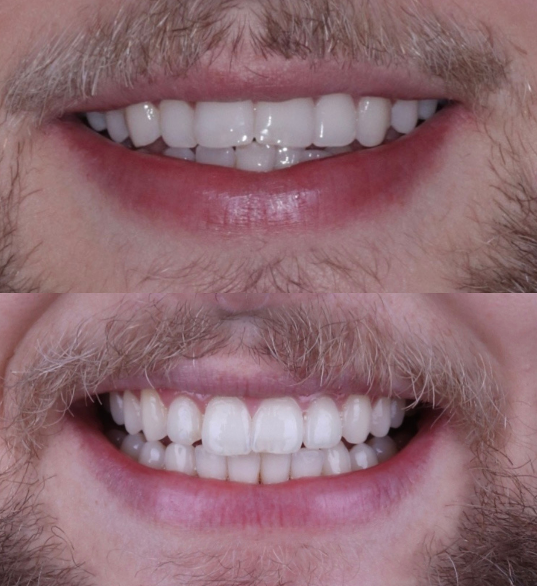 Invisalign before and after, case six