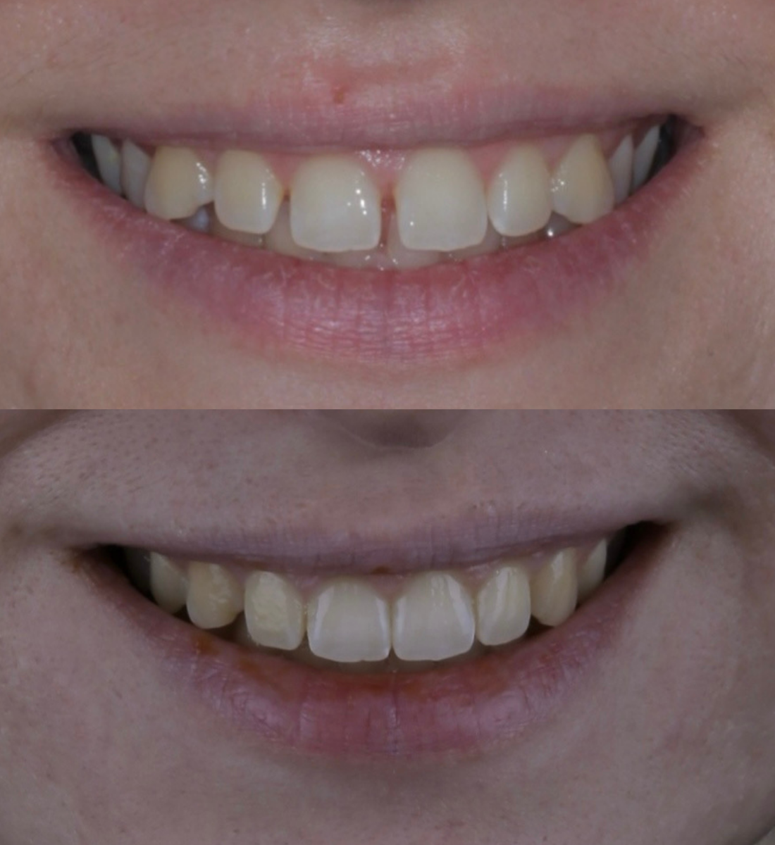 Invisalign before and after, case ten