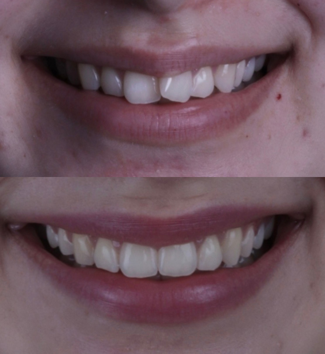 Invisalign before and after