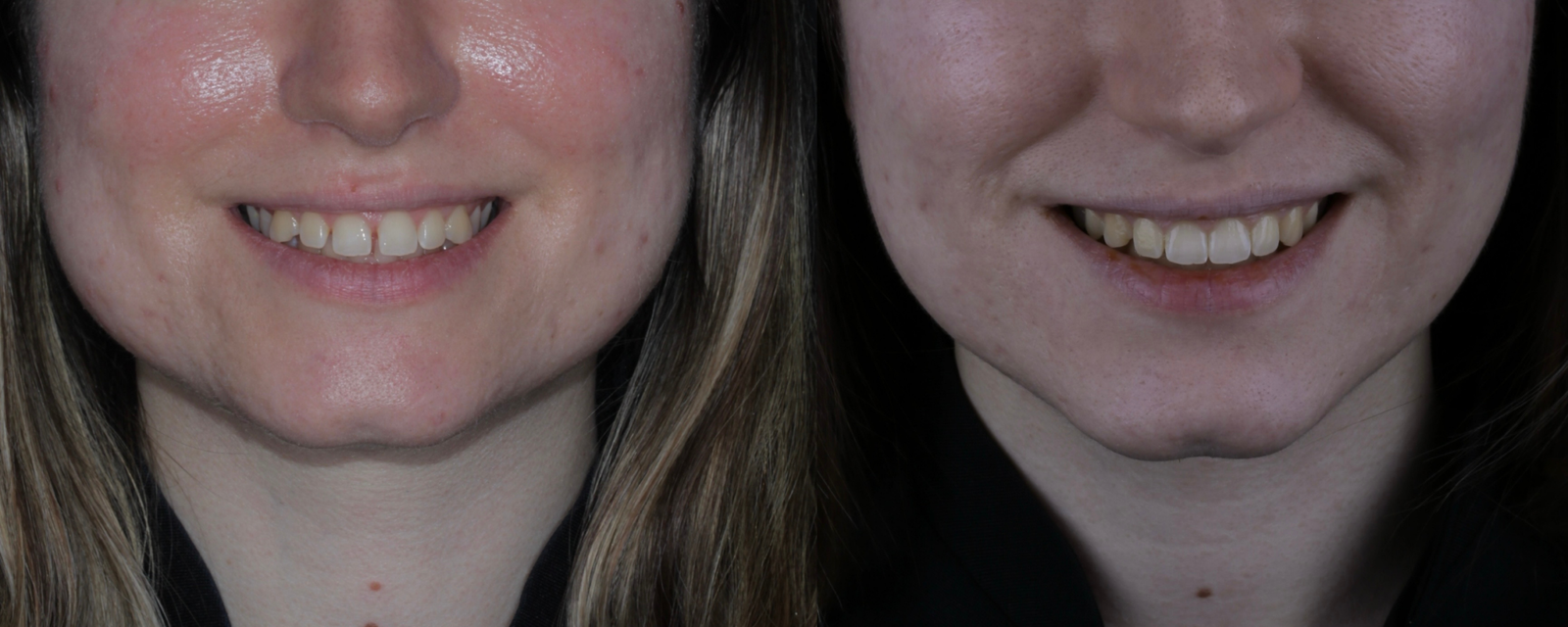 Invisalign before and after, case three