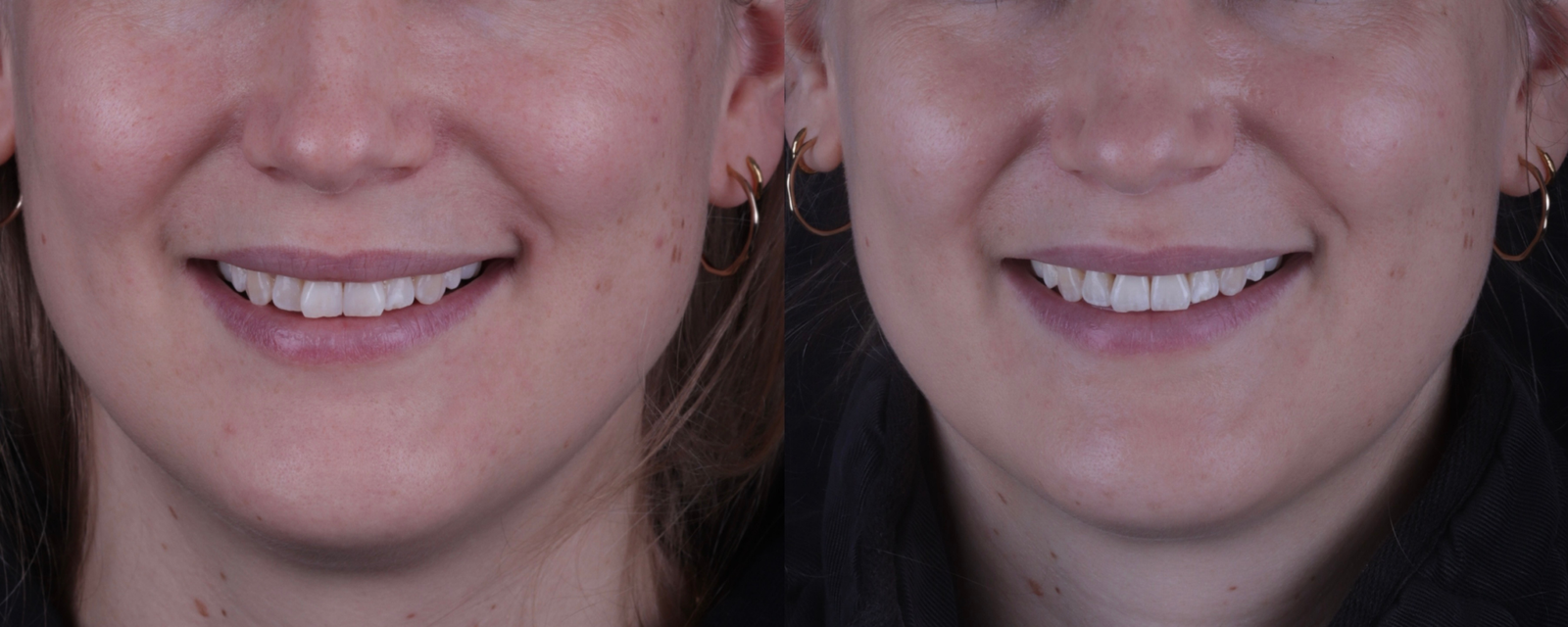 Invisalign before and after, case five