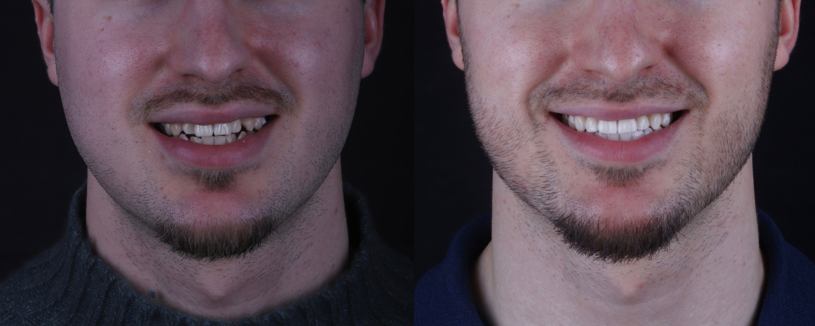 Invisalign before and after, case seven