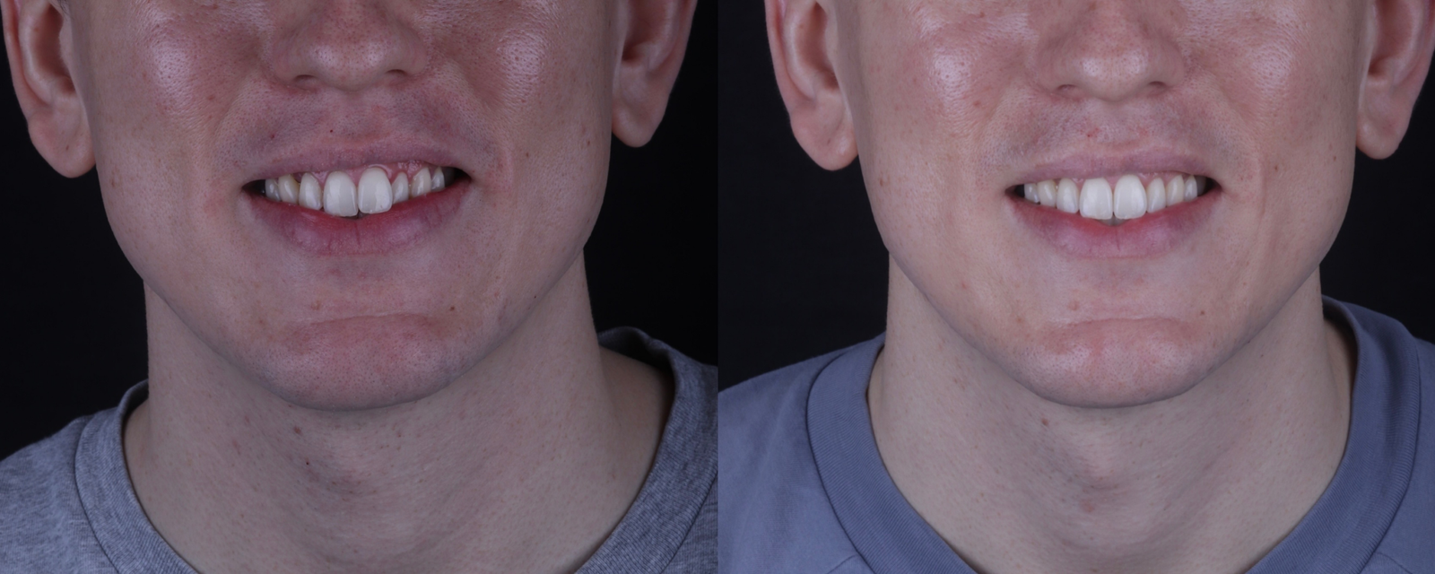 Invisalign before and after, case nine