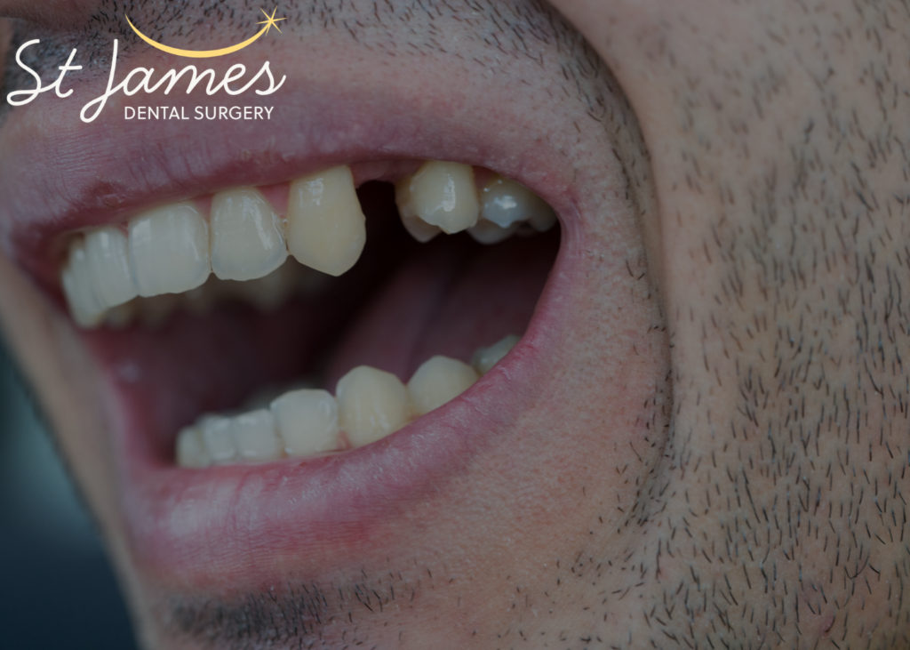 missing teeth - photo of a man missing a tooth