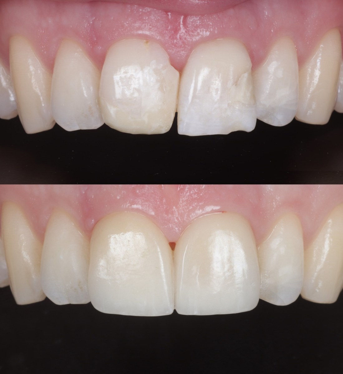 Porcelain veneers before and after