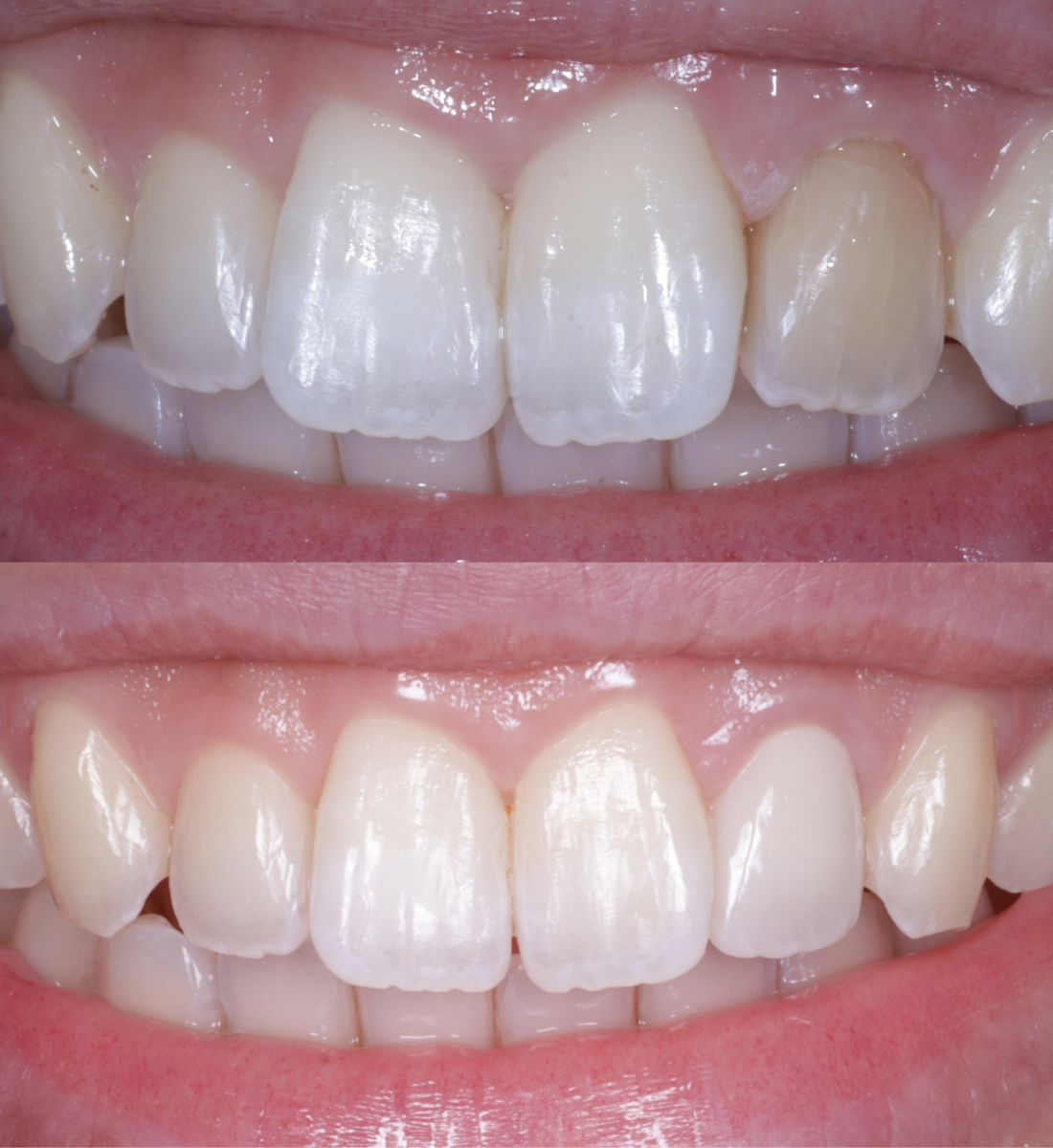 Veneers before and after