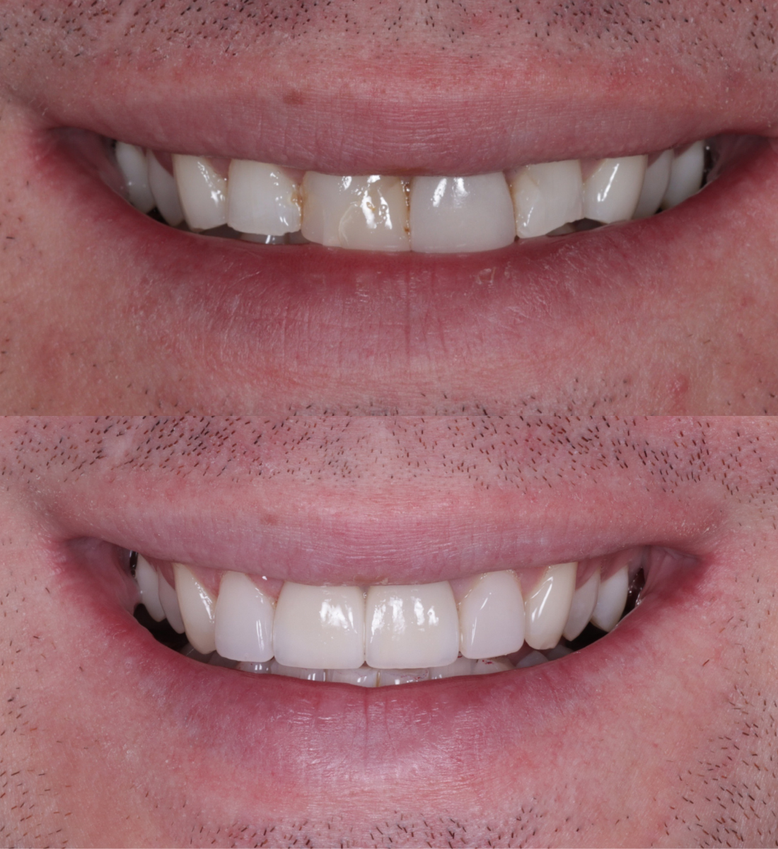 Veneers before and after