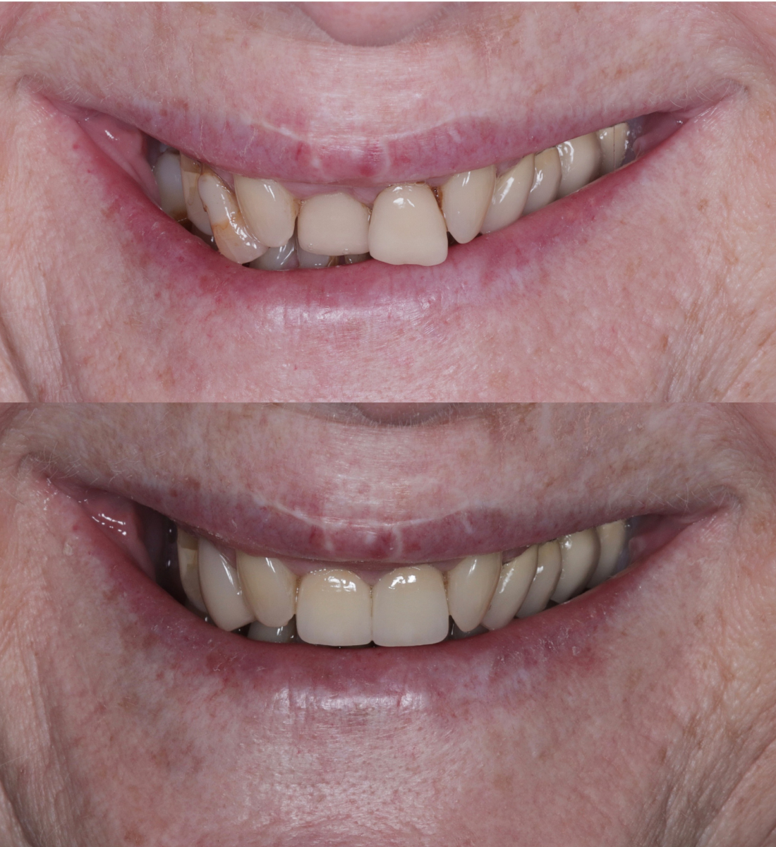 Porcelain veneers before and after