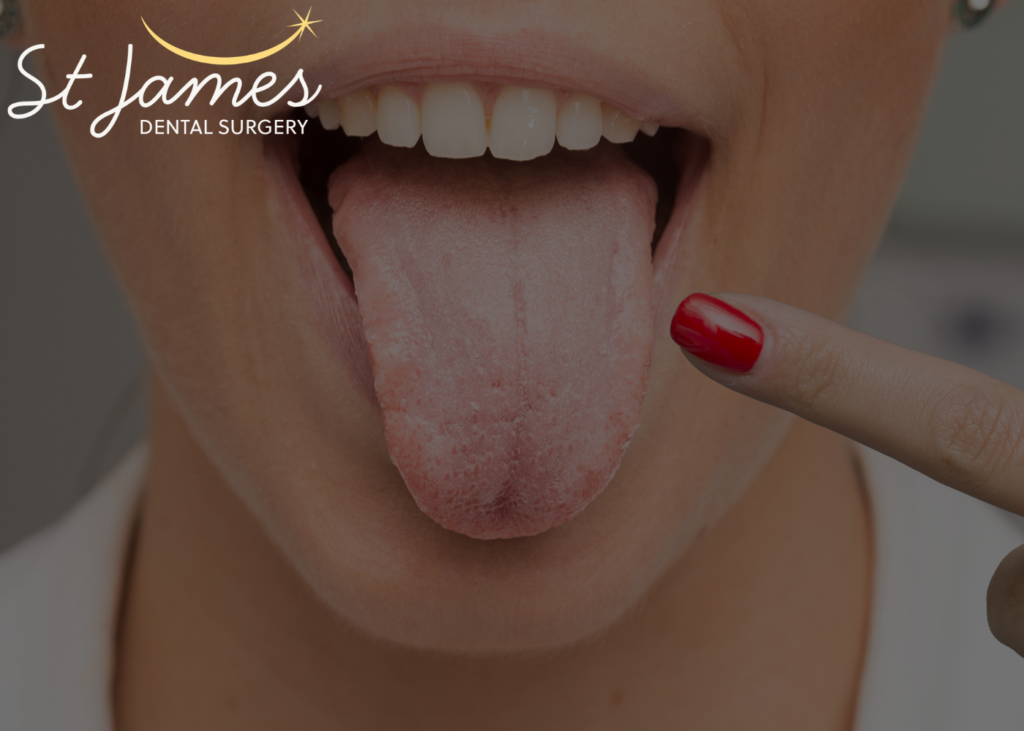 white spots on tongue - why you have it
