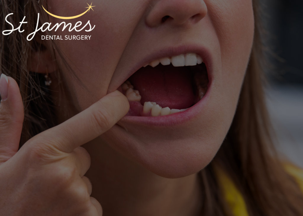 eating after tooth removal - dentist advice